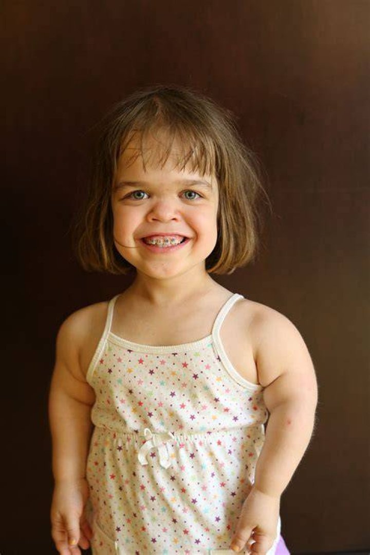 Achondroplasia Positive Exposure