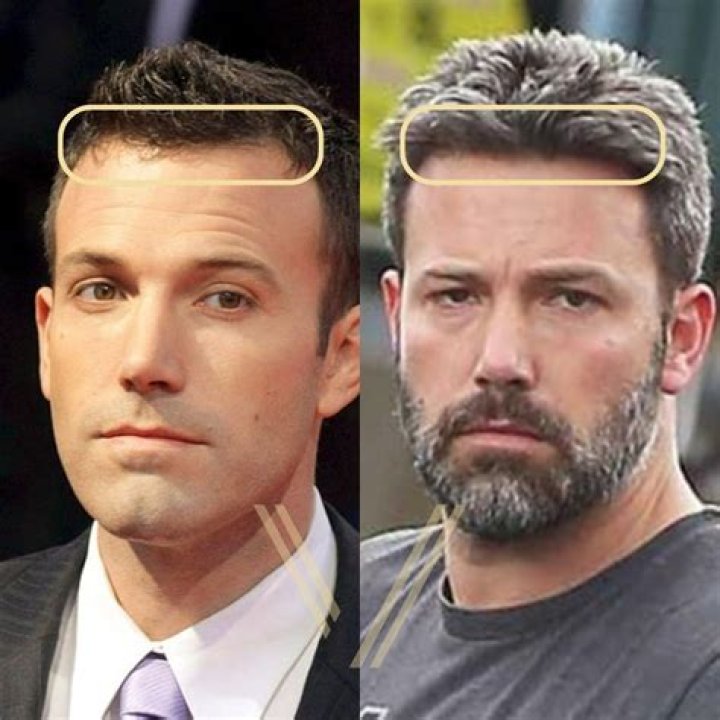 Ben Affleck Hair Transplant Hair Loss & Technical Analysis