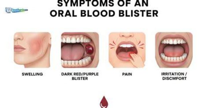 Blood Blister in Mouth Symptoms, Causes, & Treatment Health Argue