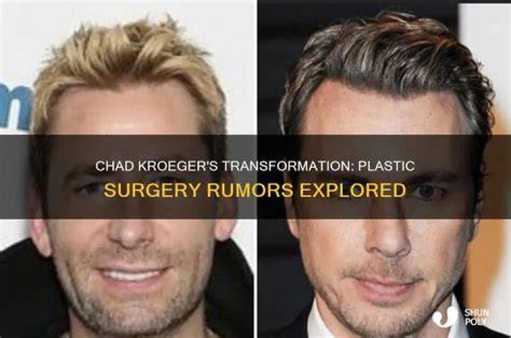 Chad Kroeger&rsquo;s Plastic Surgery The 48YearOld Canadian Singer&rsquo;s