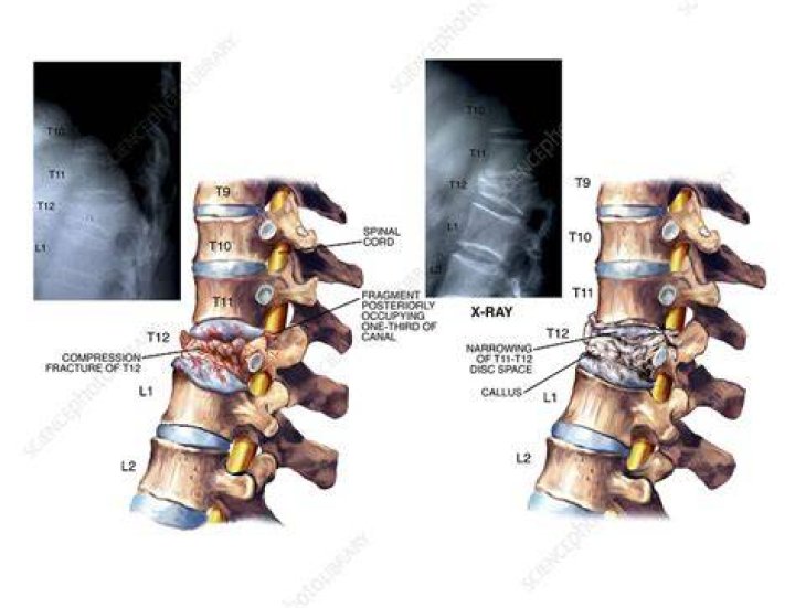 compression fracture of thoracic spine treatment for compression