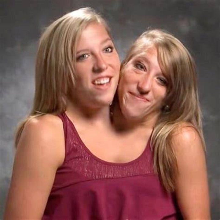 Conjoined Twins Abby & Brittany Hensel Now Their Careers, Health