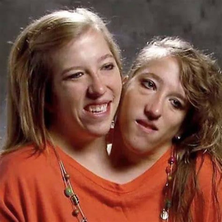 Conjoined Twins Brittany And Abby Hensel Are Married?