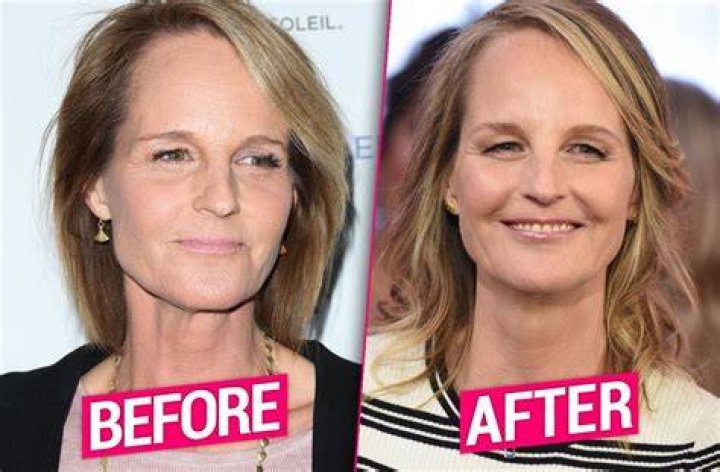 Did Helen Hunt Have Plastic Surgery? The Truth Revealed