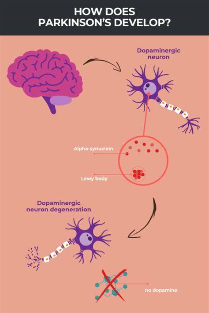 Does Parkinson's Cause Fatigue