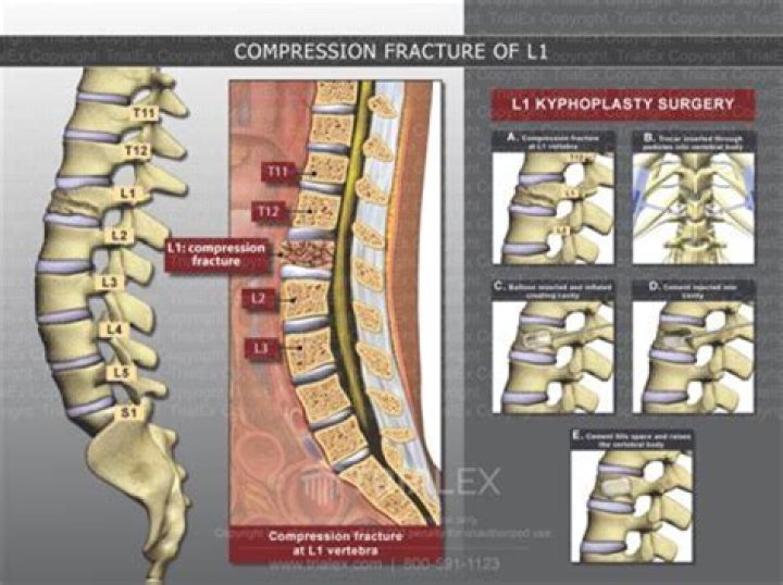[Location] T12 Vertebra Fracture: Causes, Symptoms, And Treatment Options