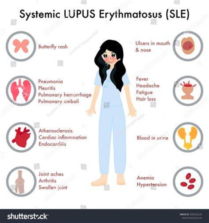 Lupus Systemic Lupus Erythematosus (SLE) Causes, Sign & Symptoms