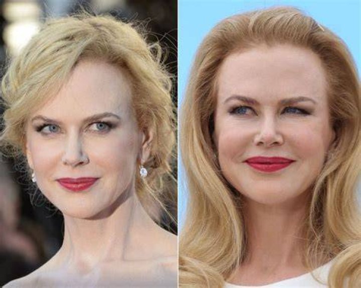 Nicole Kidman Plastic Surgery Celebrity Plastic Surge vrogue.co