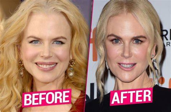 Nicole Kidman Plastic Surgery Facelift, Lip Augmentation, Breast increase