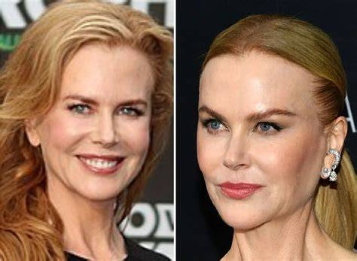 Nicole Kidman plastic surgery row 'She's ruined herself' Daily Star