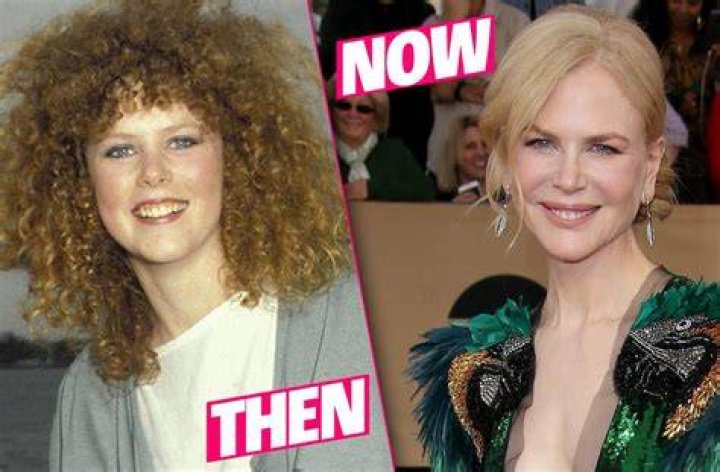 Nicole Kidman plastic surgery &Uuml;nl&uuml;ler
