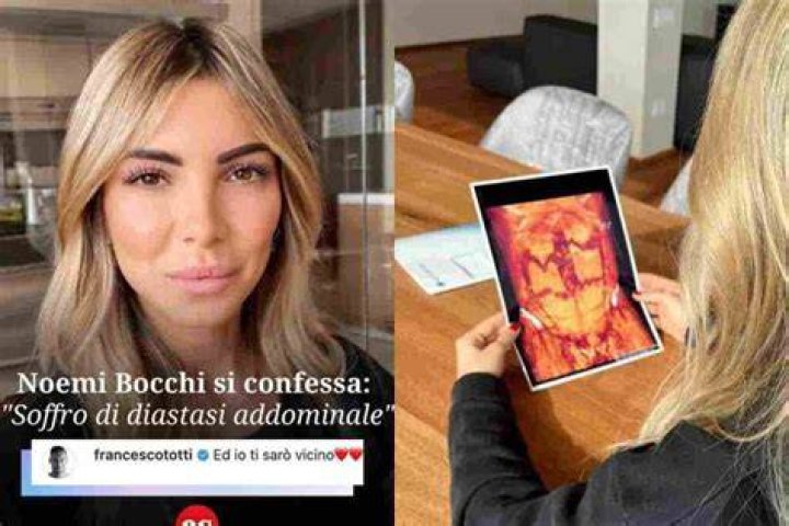 Noemi Bocchi svela la sua malattia "Soffro di diastasi addominale