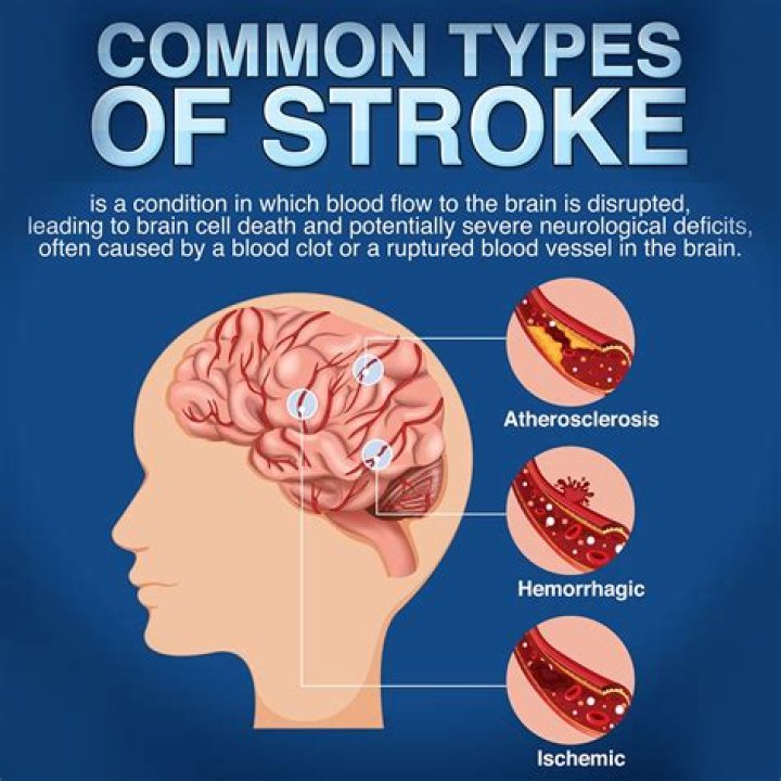 Stroke Causes, symptoms and treatment