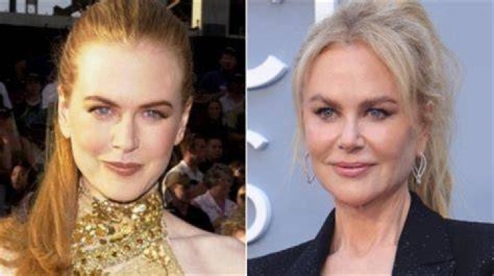 The Evolution Of Nicole Kidman's Appearance: A Look At Her Plastic Surgery Journey